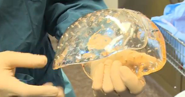 Cranio stampato in 3D - 3