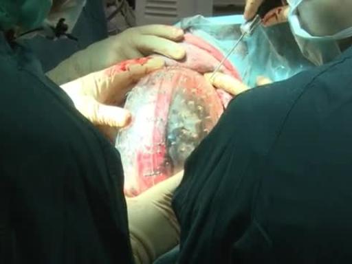 Cranio stampato in 3D - 4