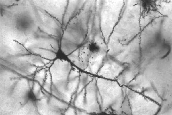 Malattie neurodegenerative: la svolta