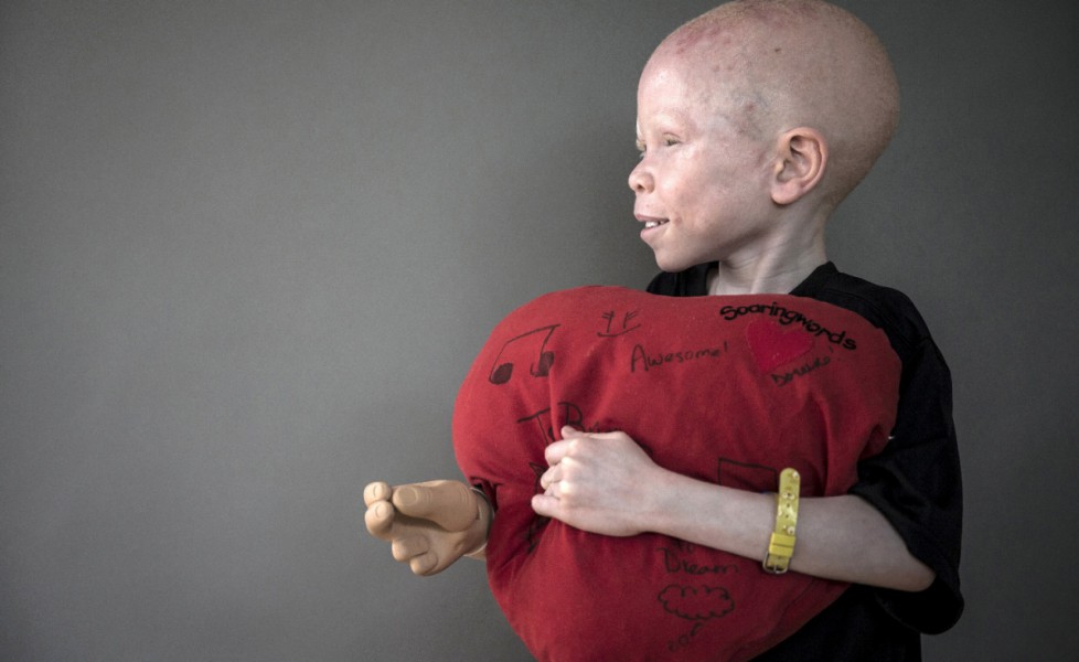 Baraka Cosma Lusambo un albino di 5 anni