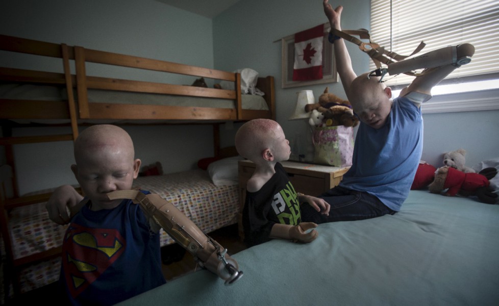 I bambini albini indossano le protesi