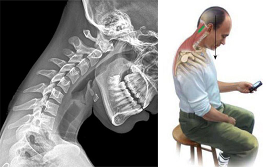Rappresentazione di come si verifica il 