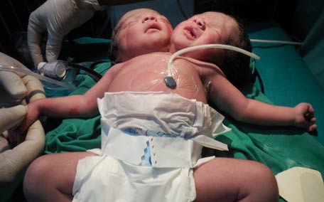 Bambina con 2 teste 2