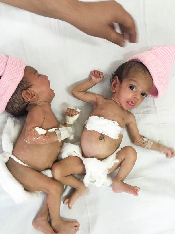 Jannat e Mannat dopo l'intervento