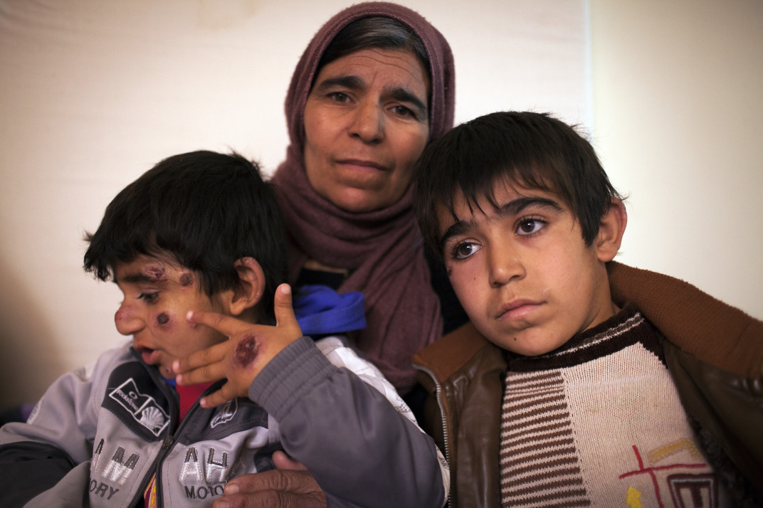 Leishmaniosi umana 4