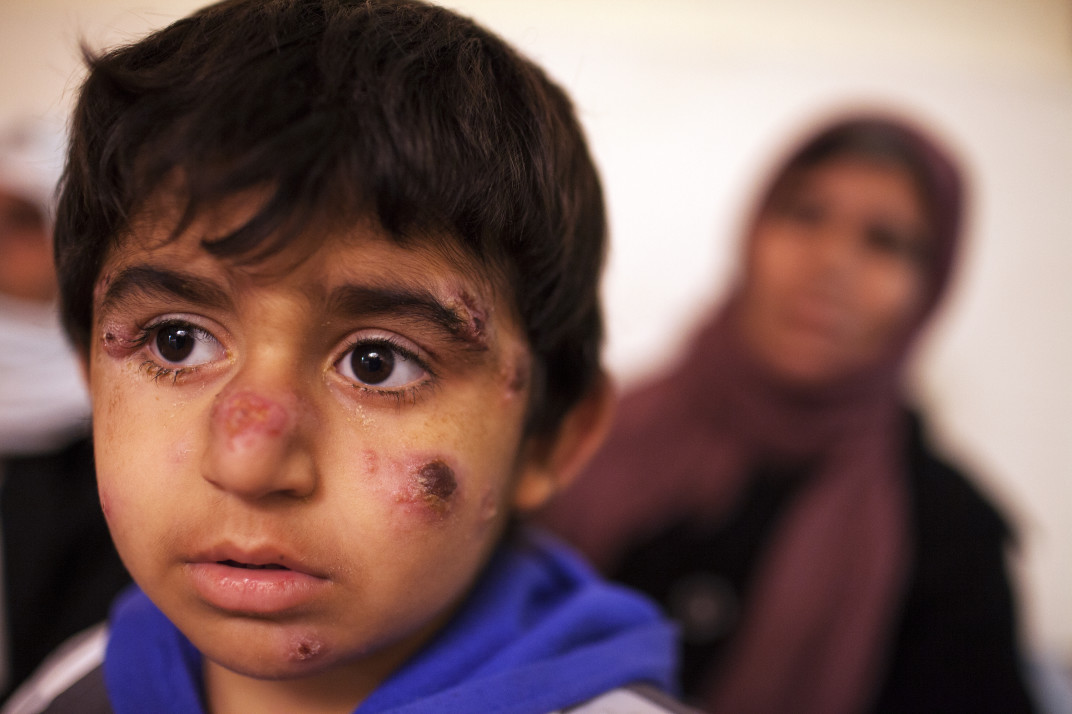 Leishmaniosi umana 3