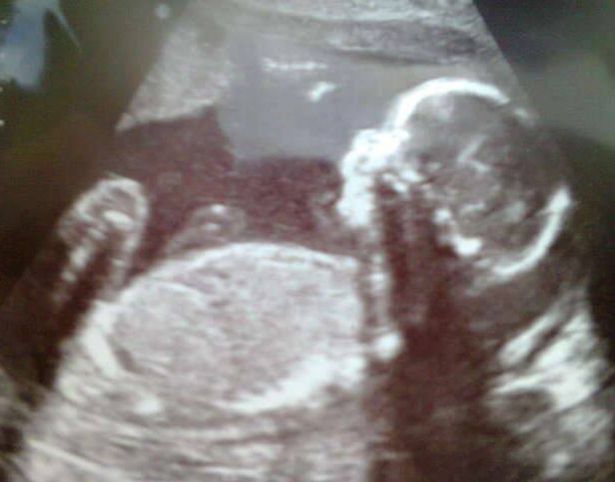 Ecografia di Ollie alla 22esima settimana