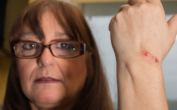 Sandra Taylor mostra la cicatrice