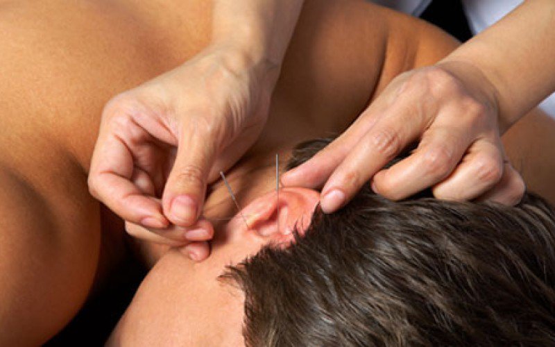 Agopuntura all'orecchio