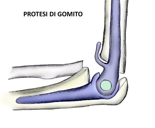 Protesi al gomito
