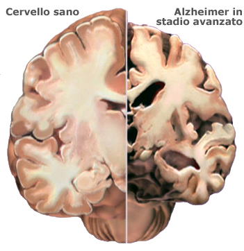 Malattie neurodegenerative