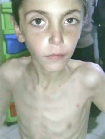 Bambini denutriti a Madaya 3