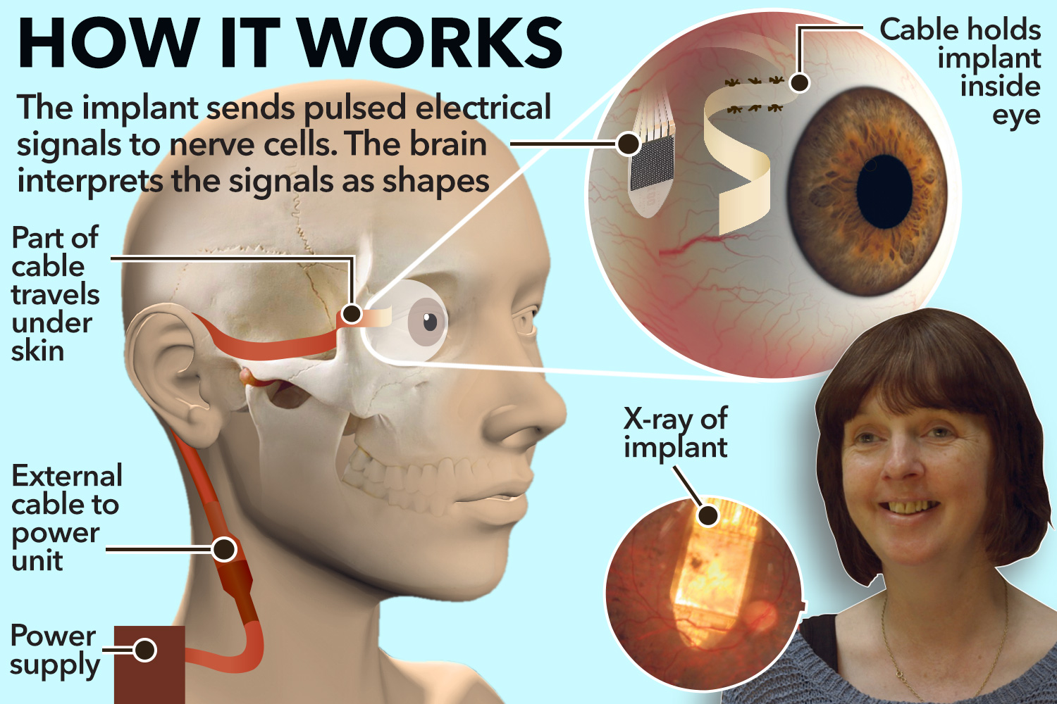 Funzionamento dell'occhio bionico
