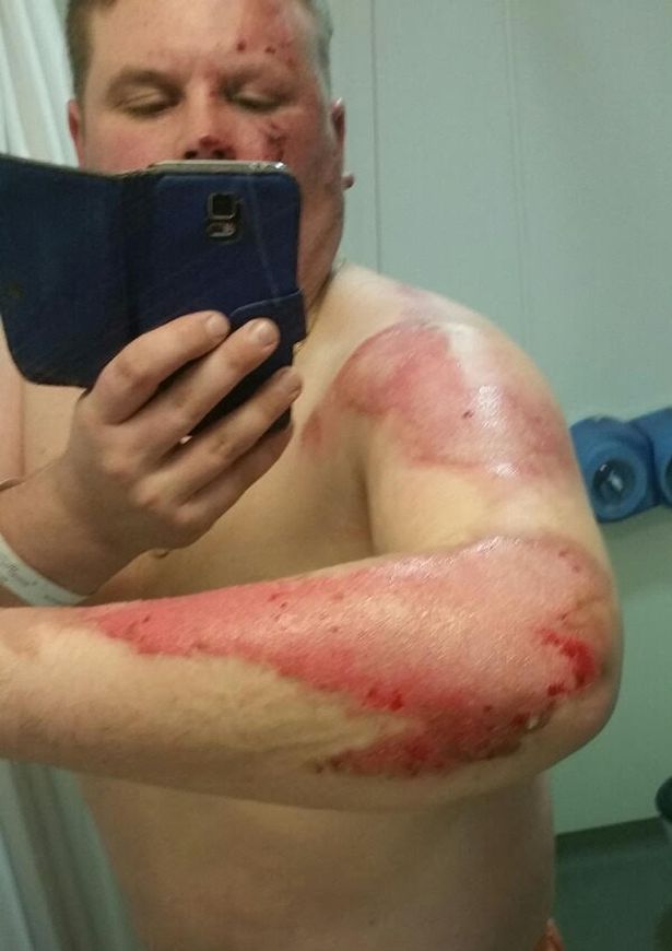 Bruciature sul braccio