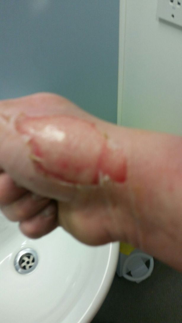 Bruciature sulla mano