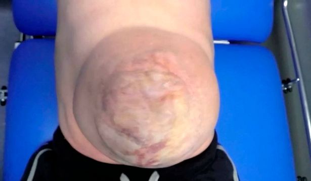 Williams e la sua ernia 2