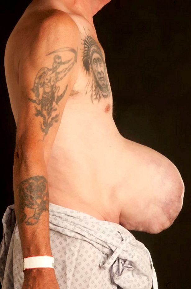 Williams e la sua ernia