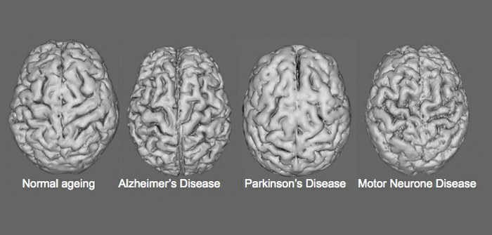 Malattie neurodegenerative