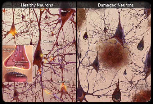 Malattie neurodegenerative
