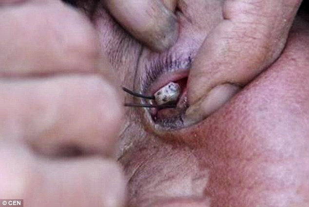 Rimozione delle pietre