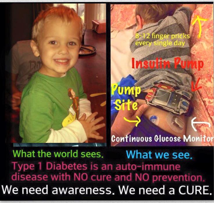 Un post di Dorrie sul diabete di tipo 1