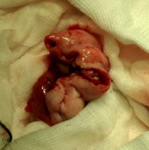 La massa tumorale appena rimossa