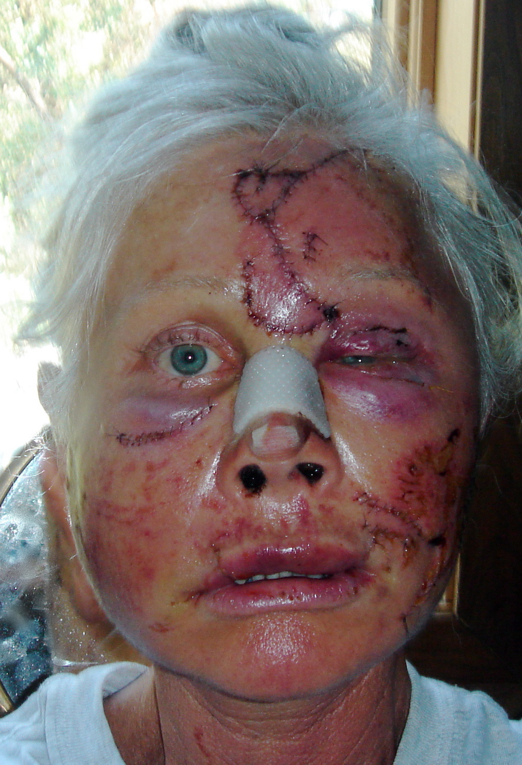 Allena Hansen dopo l'aggressione