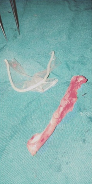 Appendice e preservativo