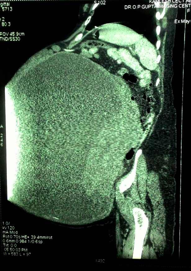La massa tumorale (2)