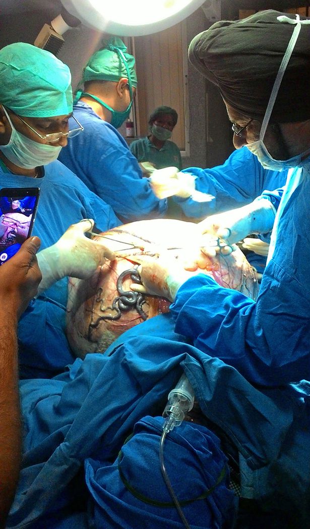 Operazione per la rimozione della massa tumorale