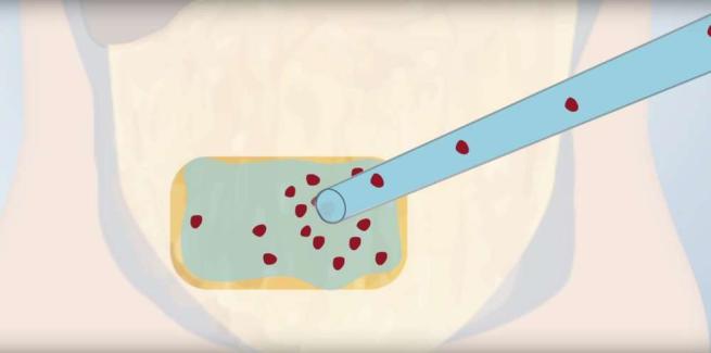 Trapianto di cellule