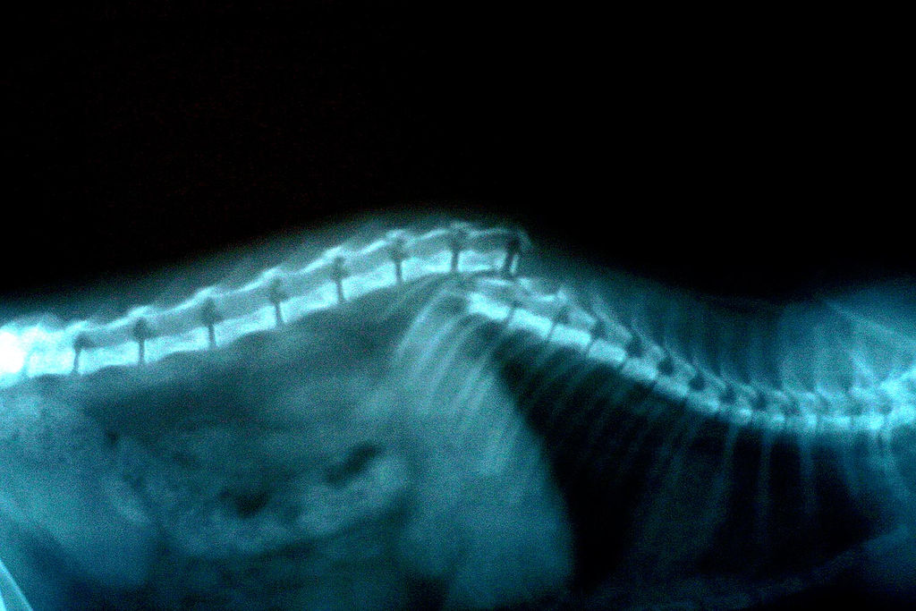 Spina dorsale fratturata