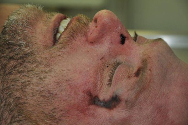 I danni sul cadavere