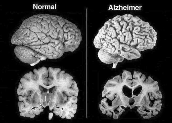 Le proteine degradate colpiscono i neuroni