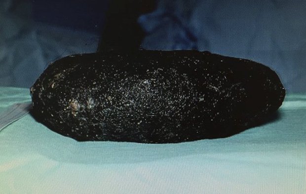 La massa di capelli rimossa da Sophie