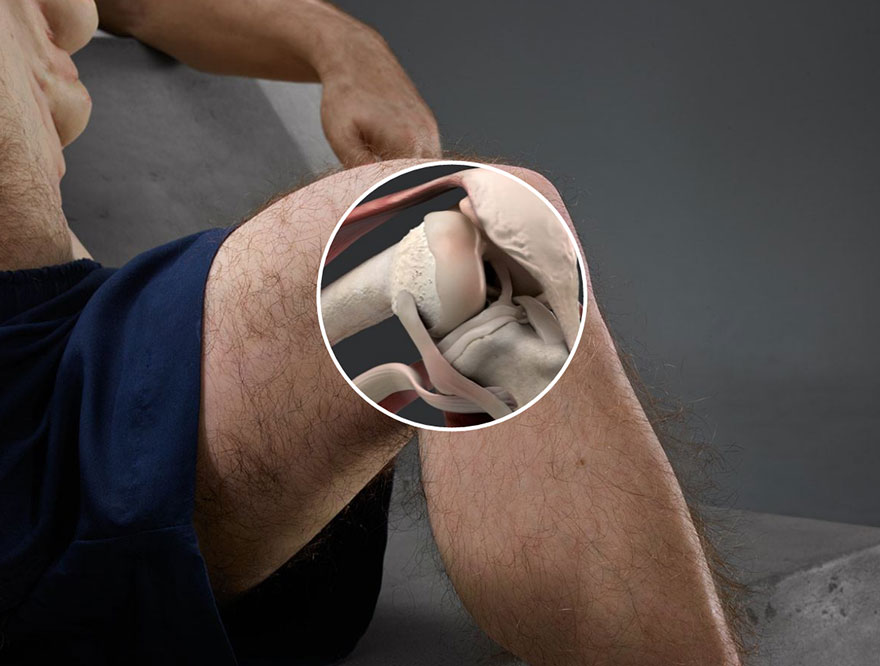 Il ginocchio di Graham