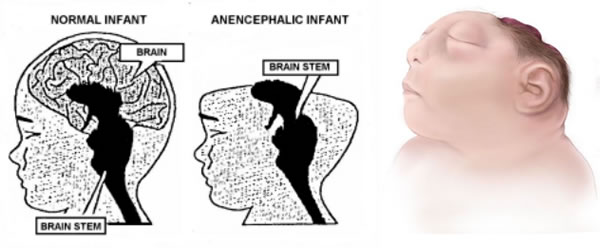 Anencefalia