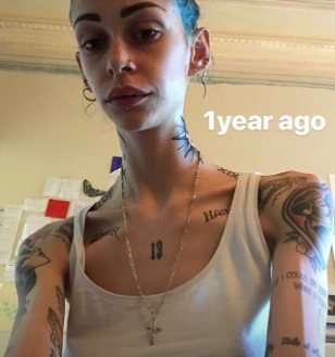 anoressia, Valentina Dallari