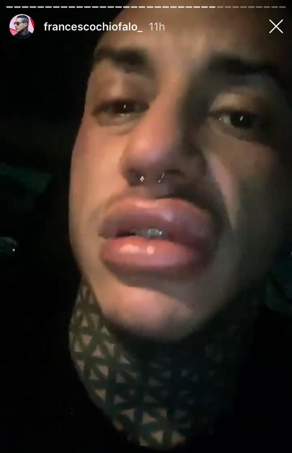 labbra gonfie, Chiofalo