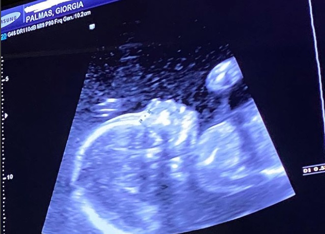 Giorgia Palmas ecografia