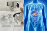 Tumore al pancreas